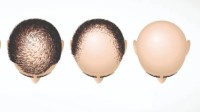 腾讯AI绘出男性秃头元凶 会导致雄激素性脱发