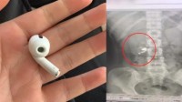 女孩睡觉时听歌误吞耳机 隔天已排出无异常