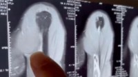 男子和朋友掰手腕肌腱断裂 医生：运动前要热身