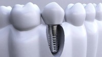 国家医保局调控种植牙医疗服务价格 一颗牙4500元