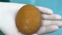 男子排尿疼痛取出鹅蛋大的结石 医生提醒：多喝水！