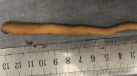 墨西哥一女婴出生时长5.7厘米尾巴 医生：属于良性组织