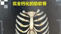 男子因缺钙在CT图像中没有肋骨 “像一个透明人”