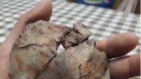 男子晒手术取出的颅骨碎片：最薄处像指甲 很好掰断
