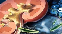 男子肾结石13.37厘米破纪录 801克成世界最大肾结石