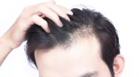近半数男性50岁开始出现脂溢性脱发！但无须担心