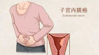 女子绝经两年又来月经 结果查出癌症
