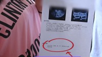 不孕女子喜获3胞胎同卵异卵同出现 医生：第一次见