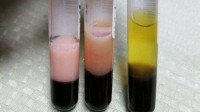 女子爱吃烧烤血液变成粉色 医生：急性重症胰腺炎