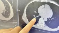 男子睡梦中虫子钻进鼻腔被呛到气管 医生：是蟑螂