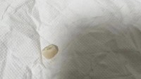 小伙躺着玩手机手滑砸断门牙 感慨iPhone钛合金真硬