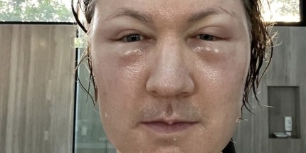 曾与儿子换血减龄富翁整脸翻车：脸肿到眼睛看不见