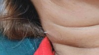 女子被鱼刺卡喉2周 最终鱼刺从脖子穿出
