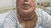 男子每天1斤酒喝出“河马颈” 长期饮酒脂肪异常堆积