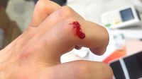 58岁渔民被海鲜刺伤数小时内身亡 感染“创伤弧菌”