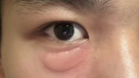 蚊子叮咬能吸走黑眼圈和眼袋?央视辟谣：没治疗效果