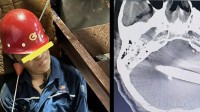 工人被拇指粗钢筋贯穿颅脑 医生双侧开颅死神手里抢人