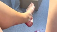 女子在家脚底喷血紧急送医 自称网上看踩指压板助眠