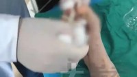 20岁姑娘一天4杯奶茶惊呆医生 引发糖尿病足险截肢