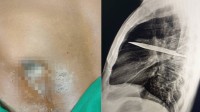 男子胸部流脓 X光发现刀留体内8年:刚好避开心脏血管